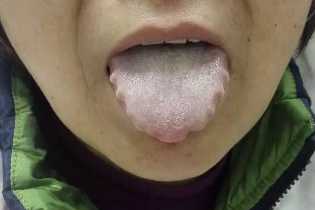 湿热舌头症状图片图片