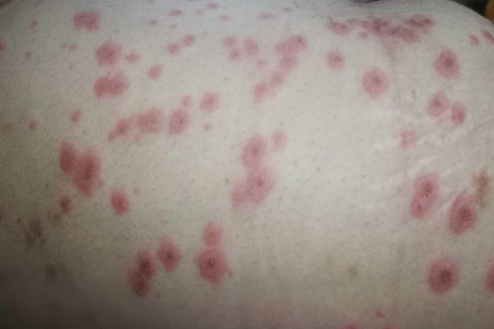 孕妇胆汁酸高皮肤瘙痒图片