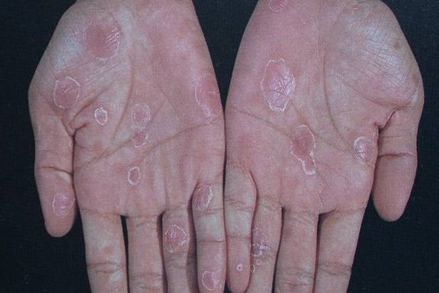 梅毒后期的皮肤图片图片