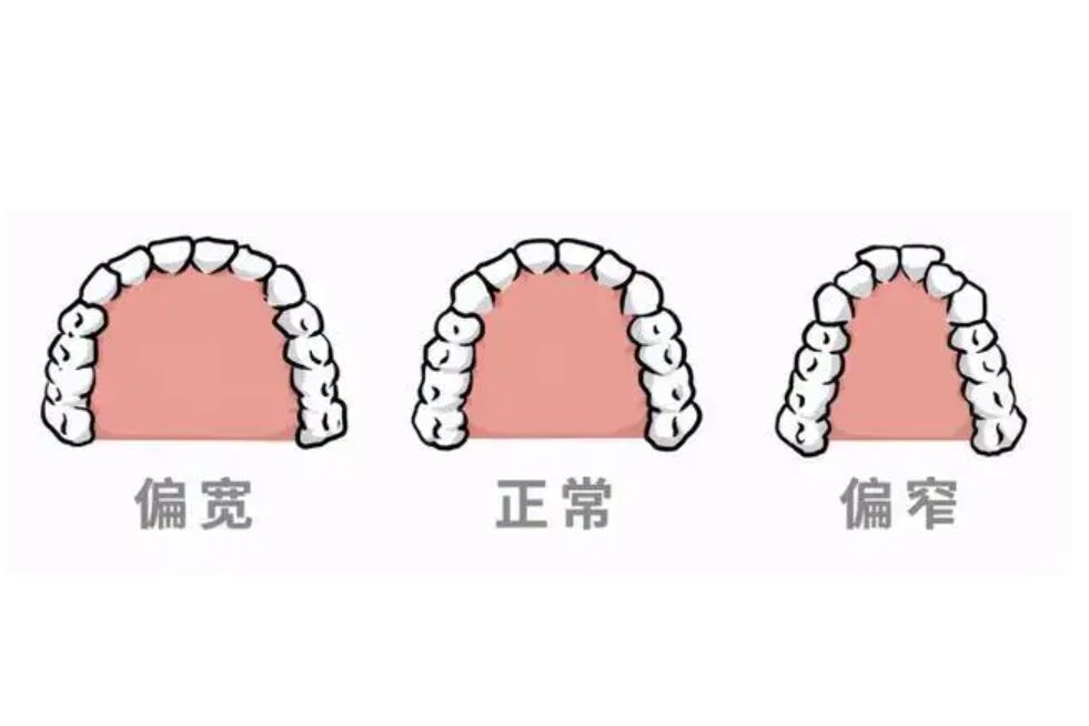 牙弓形态分几种图片图片
