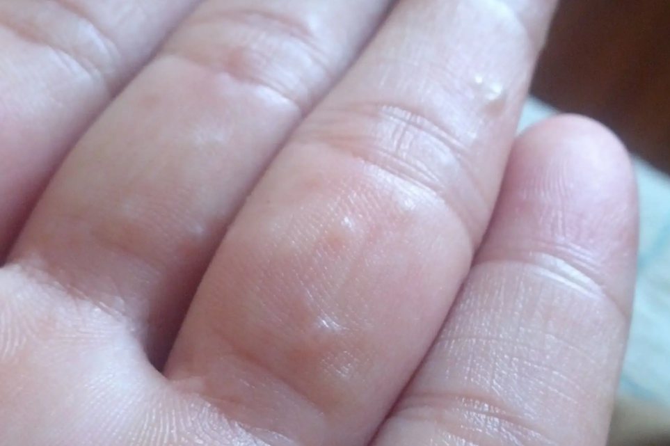 手癣早期症状图片图片