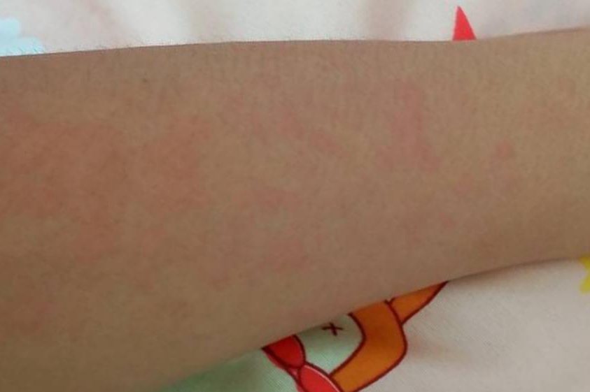 皮肤过敏真实图片