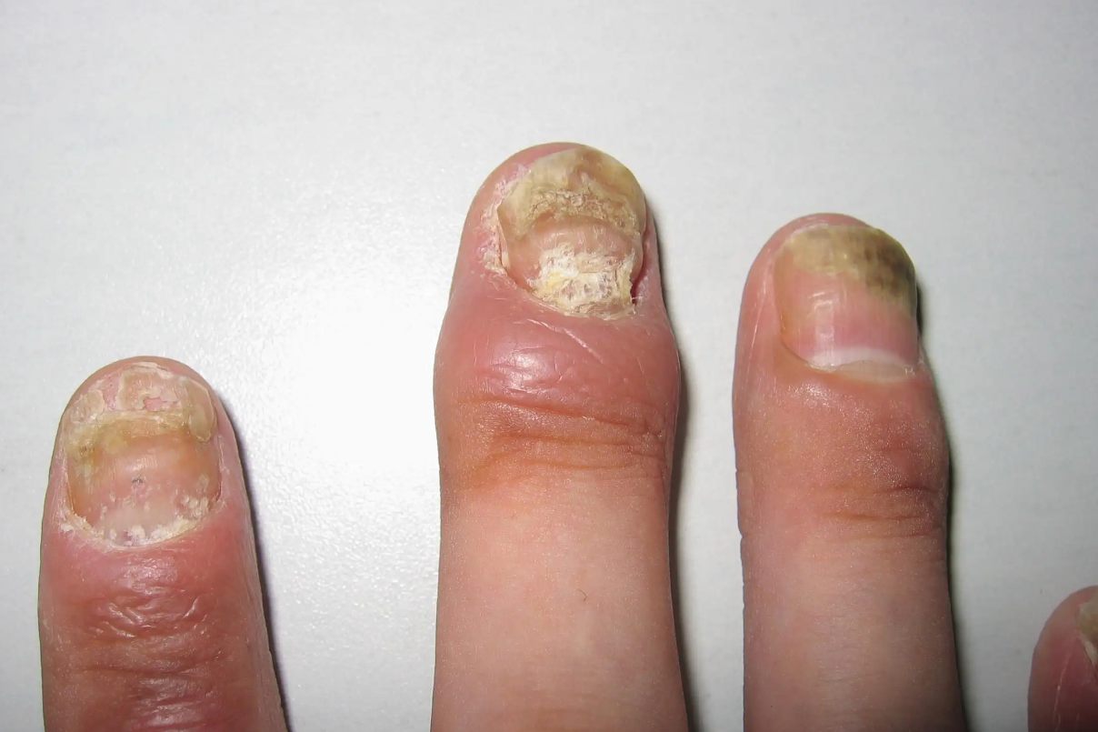 指甲病变的各种图片图片