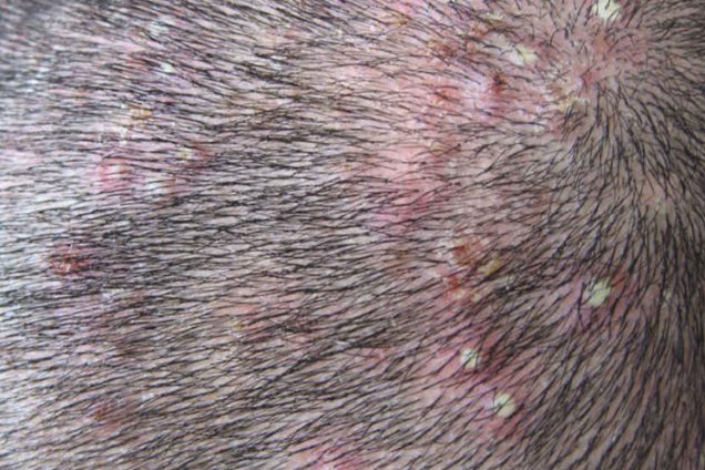 慢性毛囊炎的主要症状是以毛囊为中心的红色丘疹,有时顶部有白色脓疱