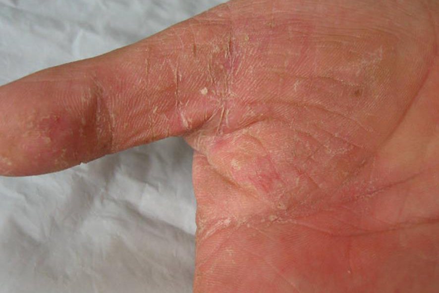 角化增厚型手癣症状图片