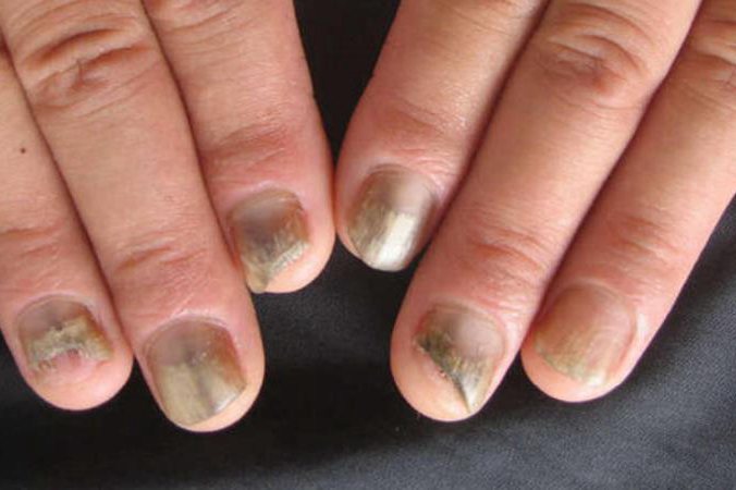 灰指甲变黑图片