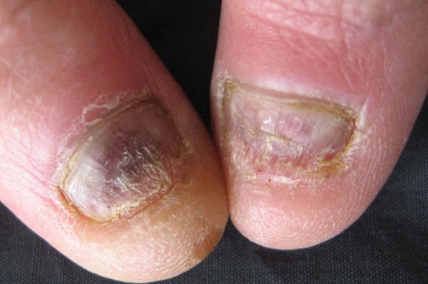 扁平苔藓指甲治疗图片