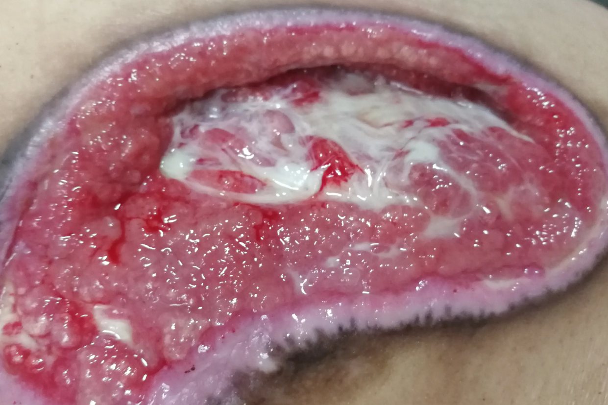 褥疮肉芽组织图片