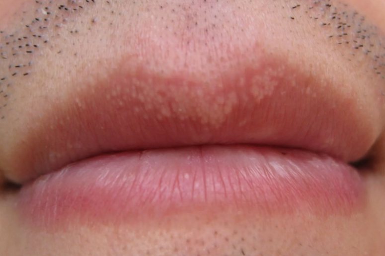 唇部皮脂腺异位症图片