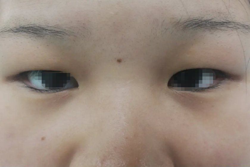 对于轻度下眼睑内翻,可以通过缝线,也就是从下眼睑的结膜面入路穿透全