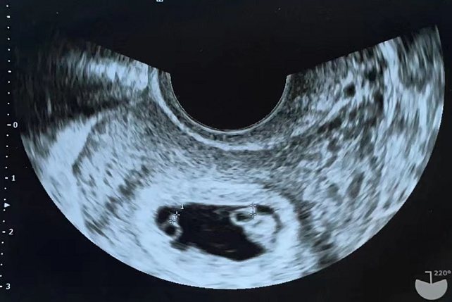 35天孕囊大小图片男孩图片