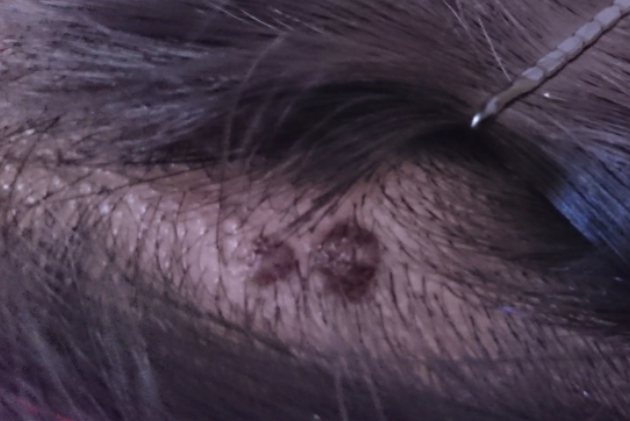 头皮痣黑色素瘤图片