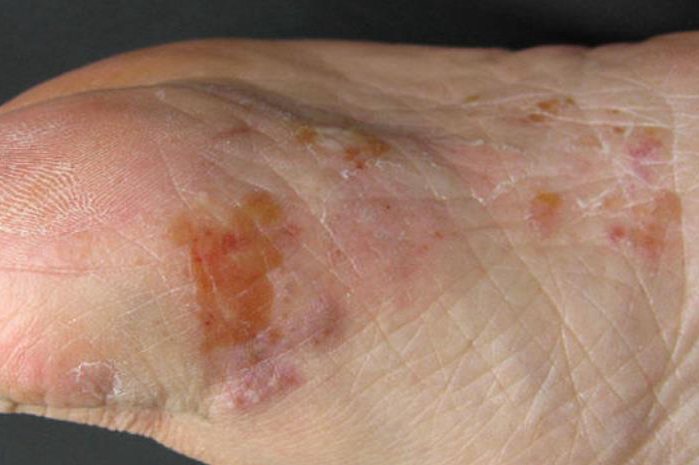脚部真菌感染肿胀图片图片