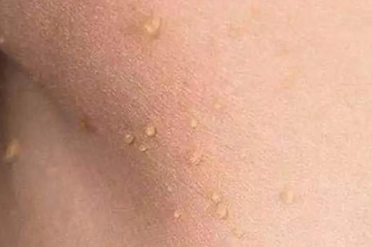 丝状疣与hpv感染相关,当皮肤出现破损时,病毒可进入表皮