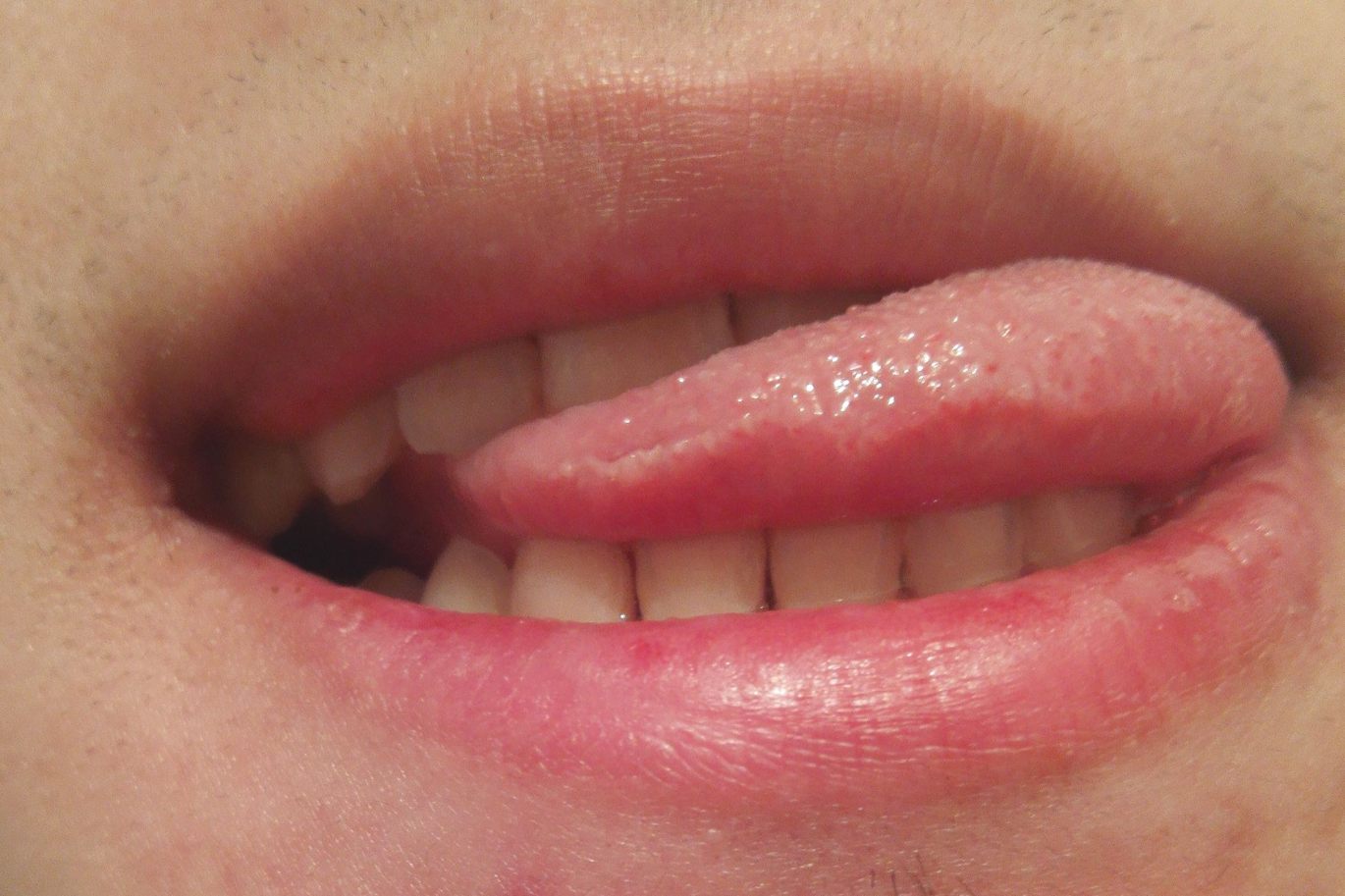 舌头红色颗粒状图片