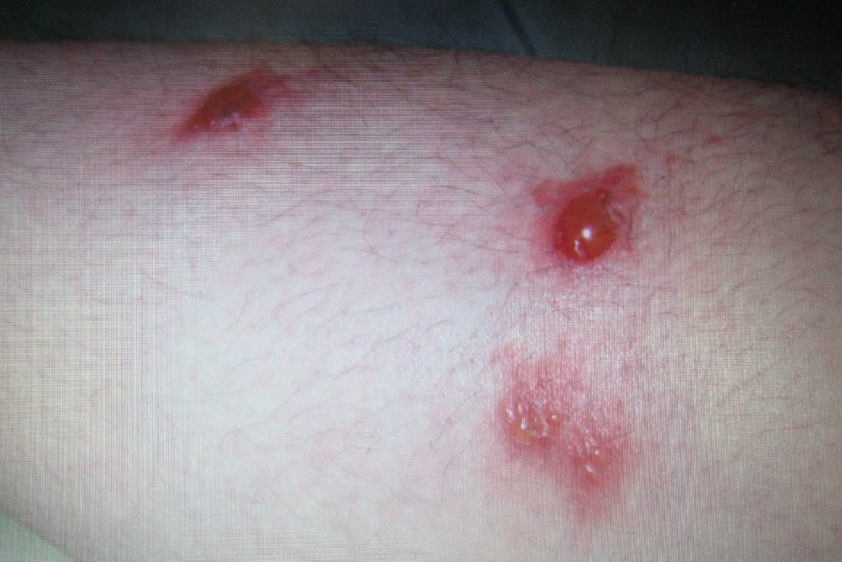 丘疹性疱疹的症状图片图片