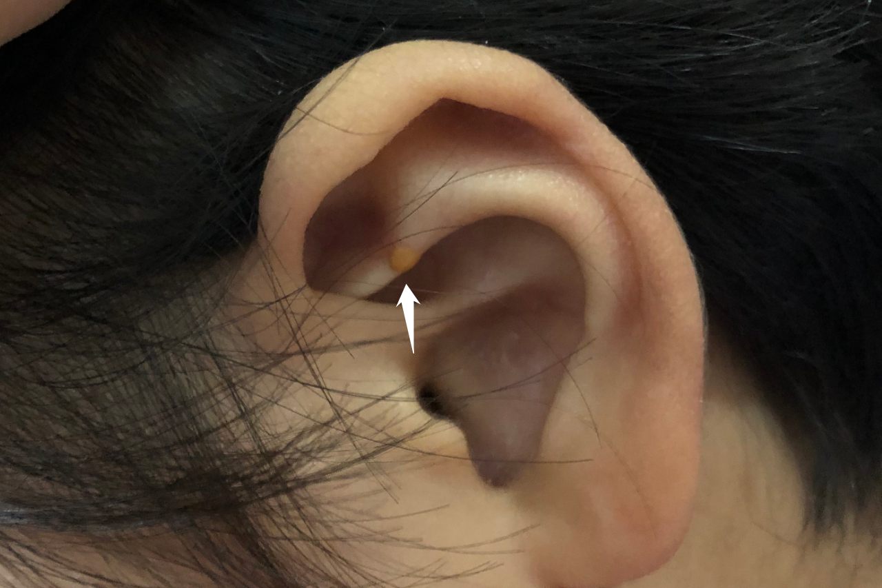 耳疖子的症状图片