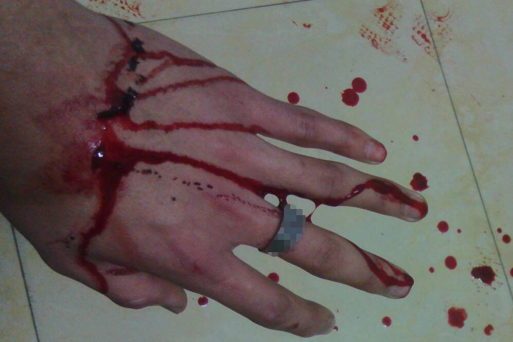 手背流血图片