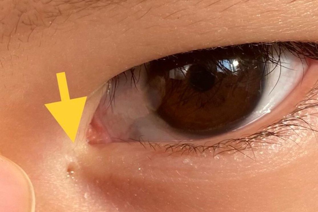 1,先天性泪管瘘,是由于胚胎发育时面裂未能很好闭合所致,通常瘘管口成