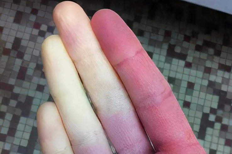 1,贫血贫血时手指常苍白,皮肤皱纹增厚,可有手指发冷的感受