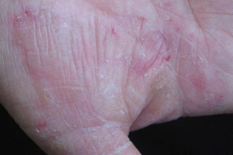 水泡鳞屑型水疱鳞屑型手癣患者通常会表现为皮肤有水疱,在水泡破裂后