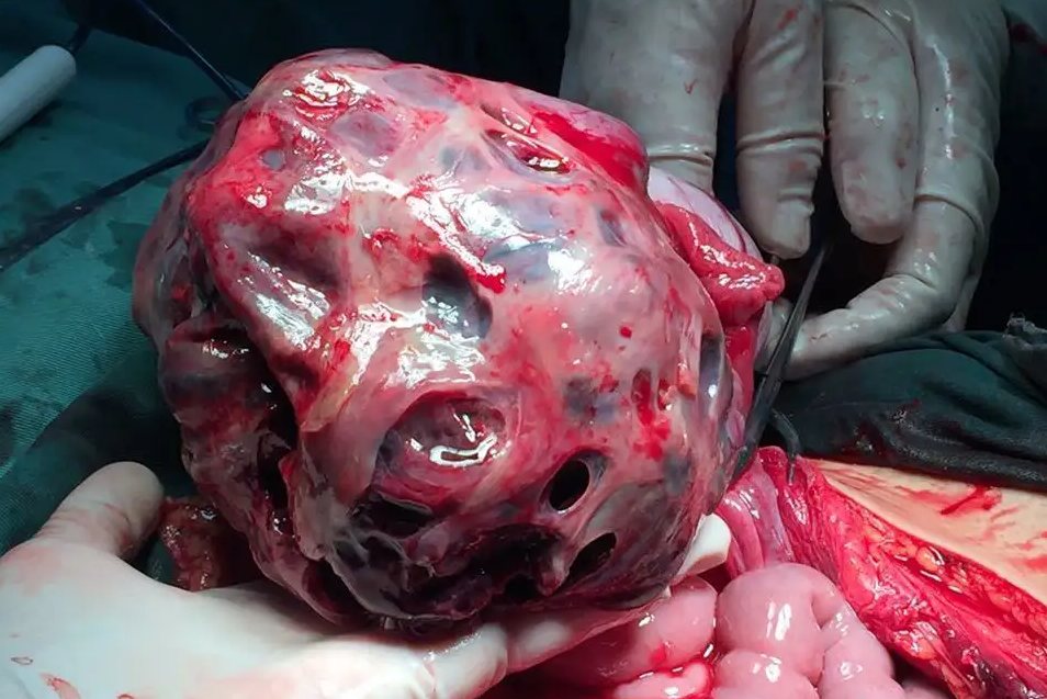 附件畸胎瘤图片