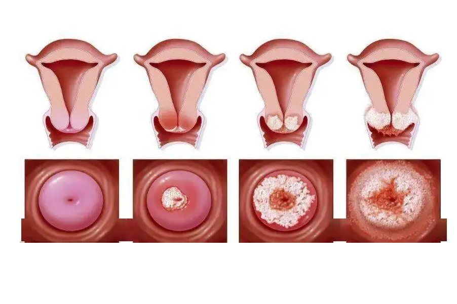 宫颈口赘生物图片图片