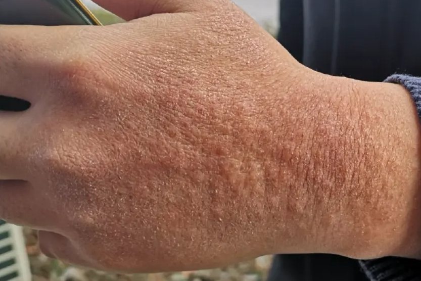 1,接触性皮炎接触性皮炎会在接触刺激性物品的皮肤表面,出现红色丘疹