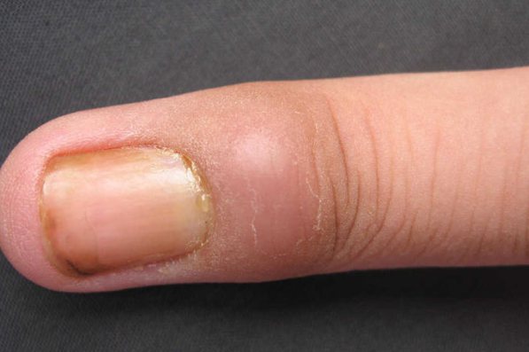 手指甲沟炎图片 初期图片