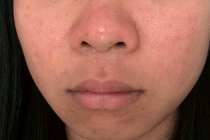 注意事项虽然脸上过敏的症状一般比较轻微,但仍需警惕病情进展,若出现