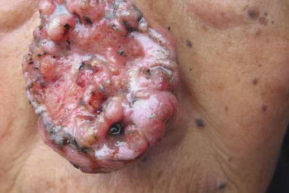 皮肤癌的具体症状图片图片