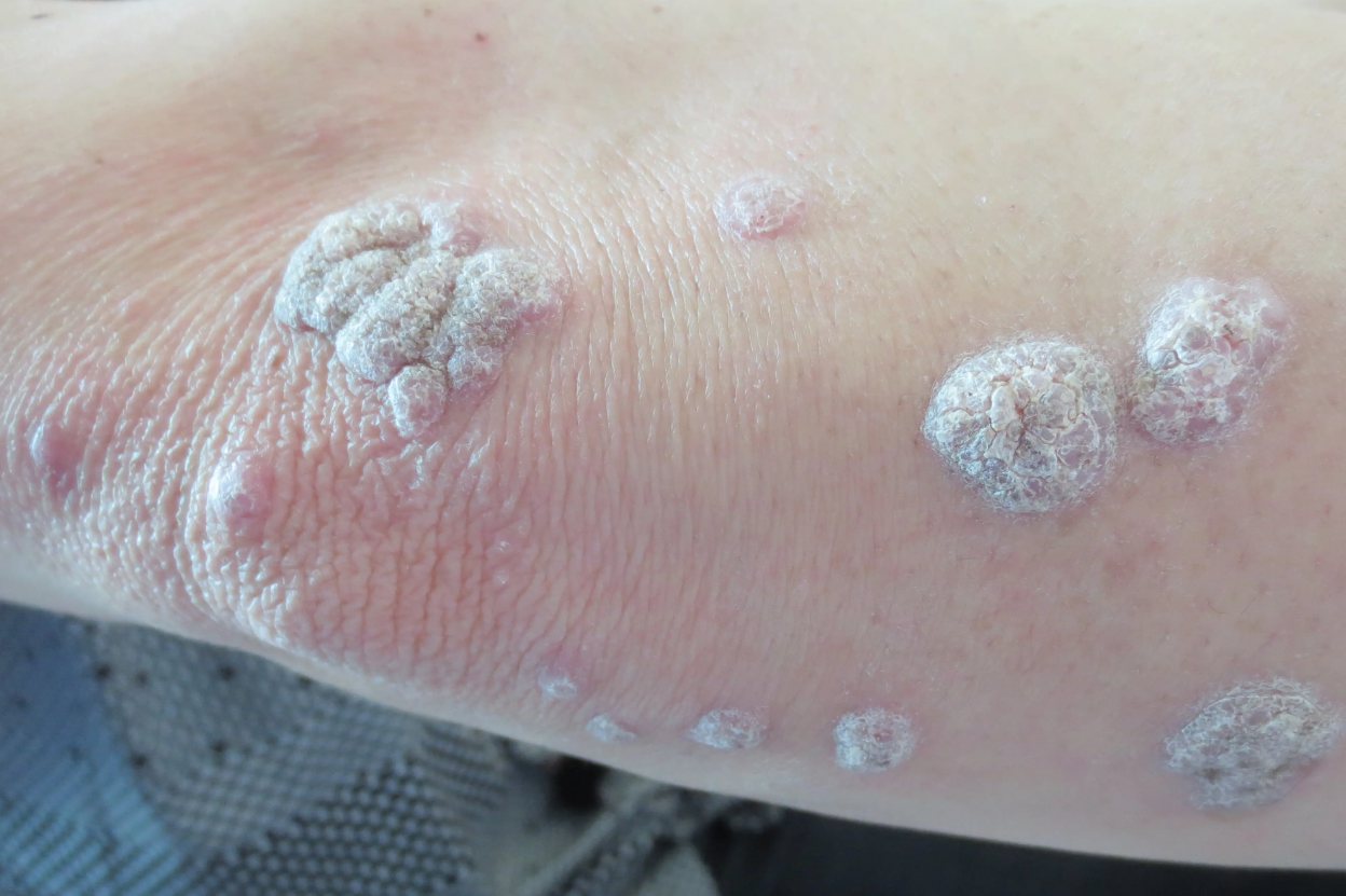 形状大小不一的红斑,周围伴有炎性红晕,表面覆盖有一层银白色鳞屑,刮