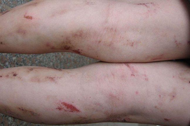 2,瘙痒轻重不一,常阵发性加重,与情绪,天气,饮