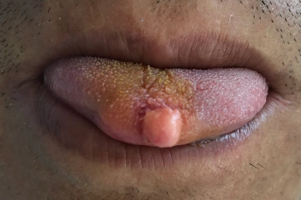 感染hpv舌头图片 病毒图片