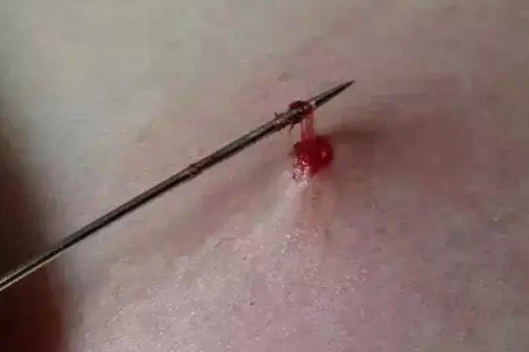 疔
